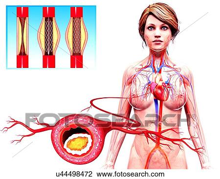 Drawing - Angioplasty, artwork. Fotosearch