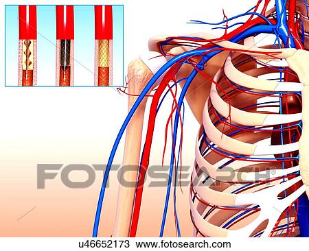 Angioplasty, artwork View Large Illustration Drawing - Angioplasty, artwork. Fotosearch
