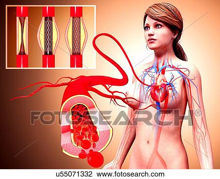 Drawing - Angioplasty, artwork. Fotosearch