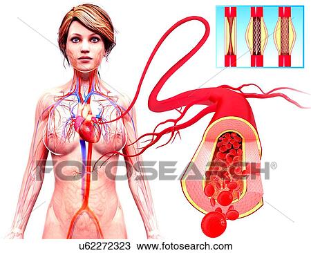 Angioplasty, artwork View Large Illustration Drawing - Angioplasty, artwork. Fotosearch