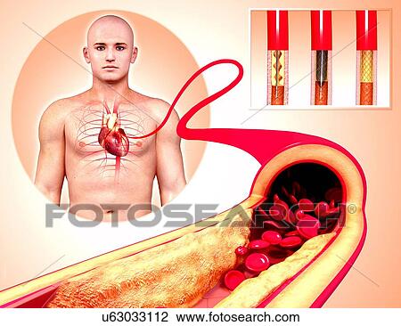 Drawing - Angioplasty, artwork. Fotosearch