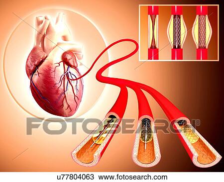 Drawing - Angioplasty, artwork. Fotosearch