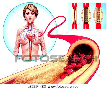 Drawing - Angioplasty, artwork. Fotosearch