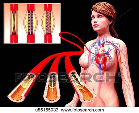 Drawing - Angioplasty, artwork. Fotosearch
