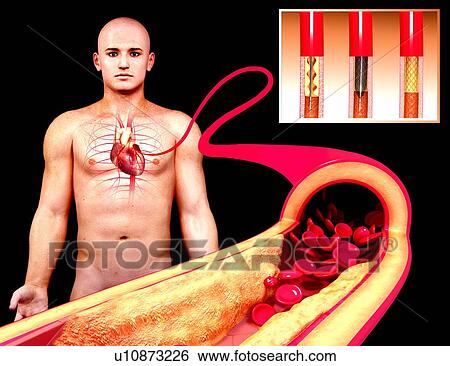 Angioplasty, artwork View Large Illustration Stock Illustration - Angioplasty, artwork. Fotosearch