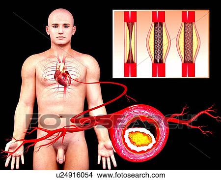 Angioplasty, artwork View Large Illustration Stock Illustration - Angioplasty, artwork. Fotosearch