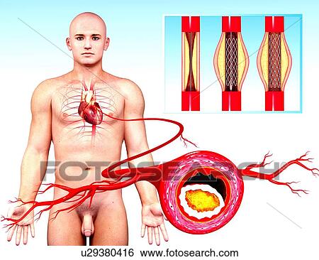 Stock Illustration - Angioplasty, artwork. Fotosearch