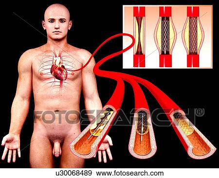 Angioplasty, artwork View Large Illustration Stock Illustration - Angioplasty, artwork. Fotosearch