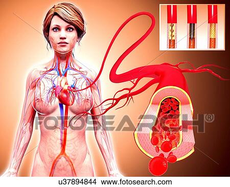 Angioplasty, artwork View Large Illustration Stock Illustration - Angioplasty, artwork. Fotosearch