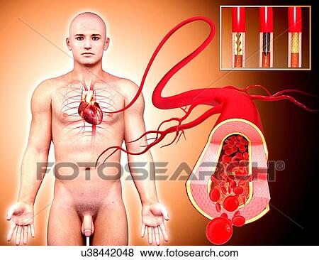 Angioplasty, artwork View Large Illustration Stock Illustration - Angioplasty, artwork. Fotosearch