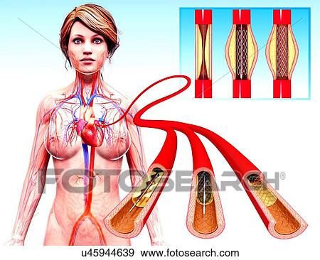 Stock Illustration - Angioplasty, artwork. Fotosearch