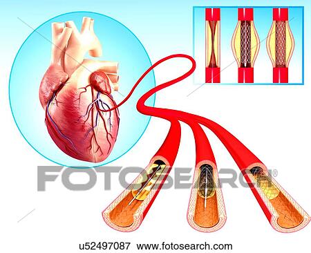 Stock Illustration - Angioplasty, artwork. Fotosearch