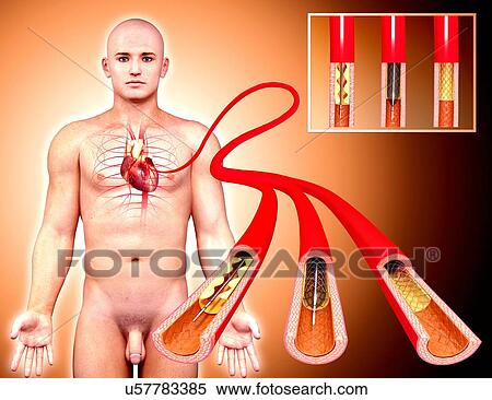 Stock Illustration - Angioplasty, artwork. Fotosearch