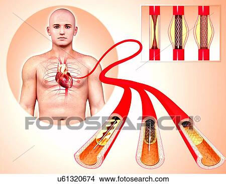 Stock Illustration - Angioplasty, artwork. Fotosearch