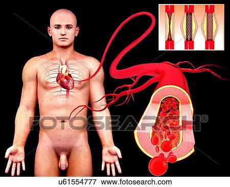Angioplasty, artwork View Large Illustration Stock Illustration - Angioplasty, artwork. Fotosearch