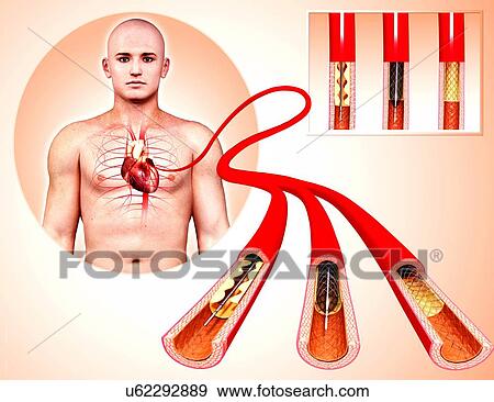 Stock Illustration - Angioplasty, artwork. Fotosearch