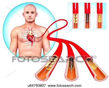 Stock Illustration - Angioplasty, artwork. Fotosearch