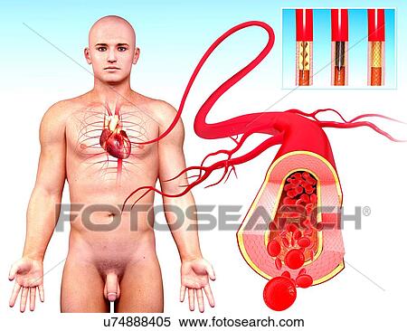 Angioplasty, artwork View Large Illustration Stock Illustration - Angioplasty, artwork. Fotosearch