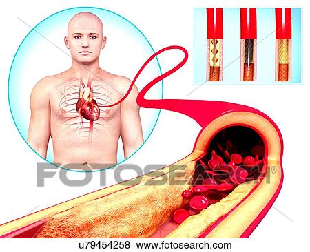Angioplasty, artwork View Large Illustration Stock Illustration - Angioplasty, artwork. Fotosearch