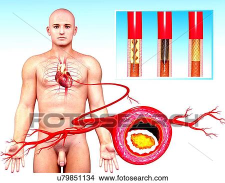 Angioplasty, artwork View Large Illustration Stock Illustration - Angioplasty, artwork. Fotosearch