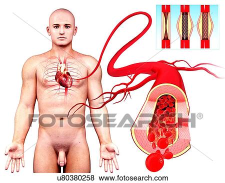 Angioplasty, artwork View Large Illustration Stock Illustration - Angioplasty, artwork. Fotosearch