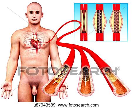 Stock Illustration - Angioplasty, artwork. Fotosearch