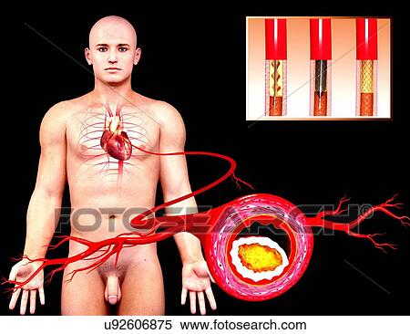 Stock Illustration - Angioplasty, artwork. Fotosearch