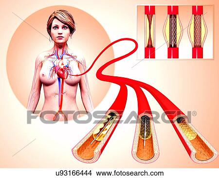 Angioplasty, artwork View Large Illustration Stock Illustration - Angioplasty, artwork. Fotosearch