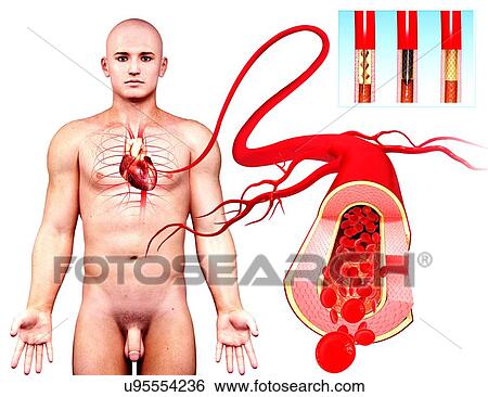 Angioplasty, artwork View Large Illustration Stock Illustration - Angioplasty, artwork. Fotosearch
