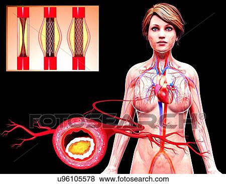 Angioplasty, artwork View Large Illustration Stock Illustration - Angioplasty, artwork. Fotosearch