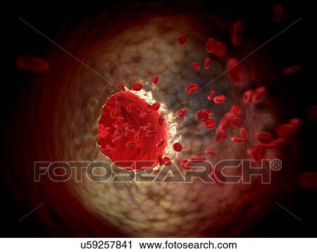 Arteriosclerosis, artwork View Large Illustration Clip Art - Arteriosclerosis, artwork. Fotosearch