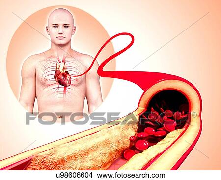 Stock Illustration - Atherosclerosis, artwork. Fotosearch