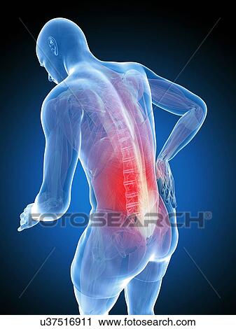 Clip Art - Back pain, artwork. Fotosearch