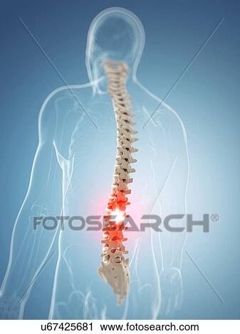 Clip Art - Back pain, artwork. Fotosearch