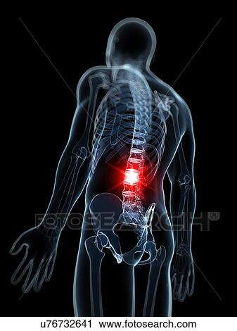 Back pain, artwork View Large Illustration Clip Art - Back pain, artwork. Fotosearch