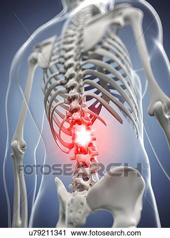 Back pain, artwork View Large Illustration Clip Art - Back pain, artwork. Fotosearch
