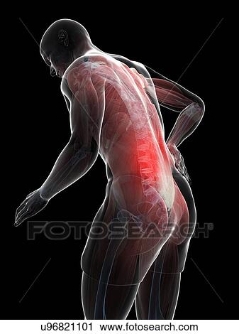 Clip Art - Back pain, artwork. Fotosearch