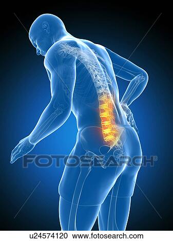 Clipart - Back pain, artwork. Fotosearch