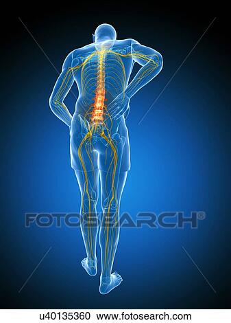 Clipart - Back pain, artwork. Fotosearch