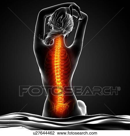 Drawing - Back pain, artwork. Fotosearch