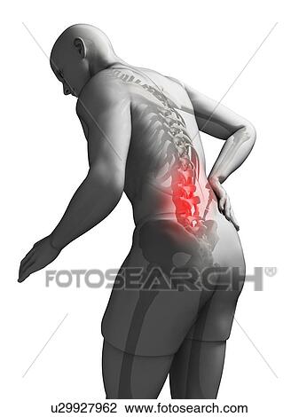 Drawing - Back pain, artwork. Fotosearch