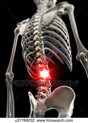 Back pain, artwork View Large Illustration Drawing - Back pain, artwork. Fotosearch