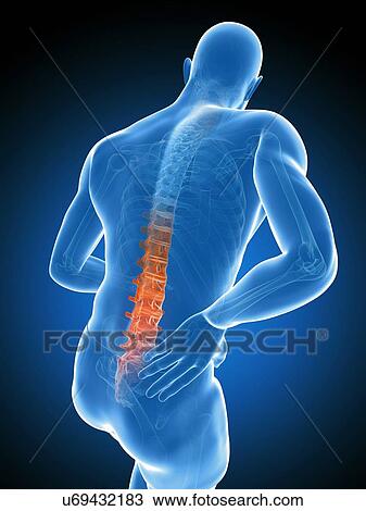 Drawing - Back pain, artwork. Fotosearch
