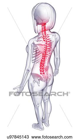 Drawing - Back pain, artwork. Fotosearch