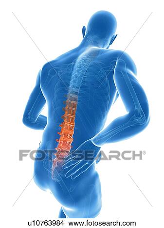 Stock Illustration - Back pain, artwork. Fotosearch