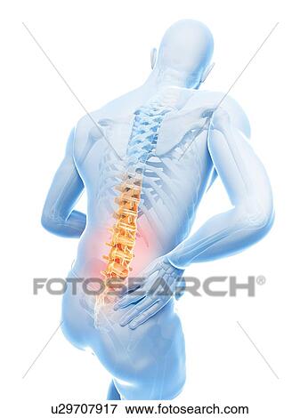 Stock Illustration - Back pain, artwork. Fotosearch