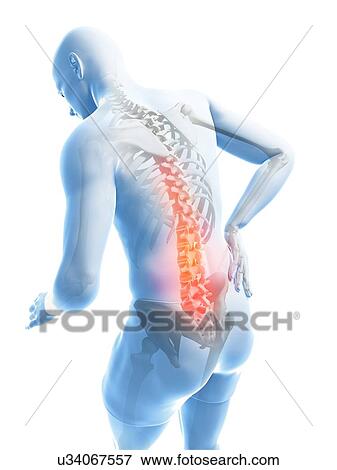 Stock Illustration - Back pain, artwork. Fotosearch