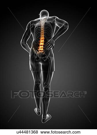 Stock Illustration - Back pain, artwork. Fotosearch