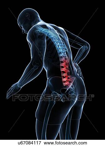 Stock Illustration - Back pain, artwork. Fotosearch