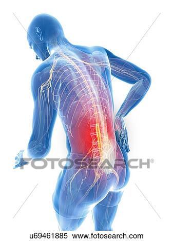 Stock Illustration - Back pain, artwork. Fotosearch